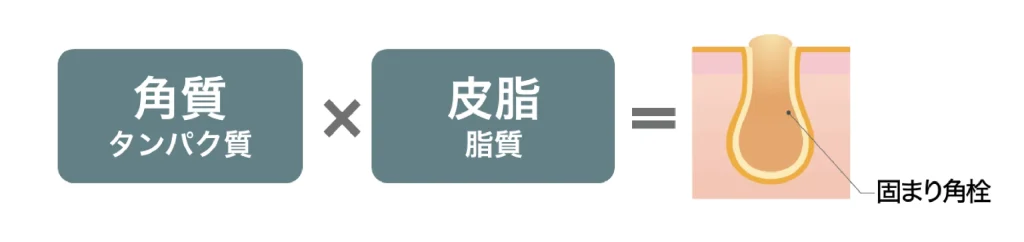 古い角質や皮脂が「固まり角栓」になってしまうことを説明しているイラスト